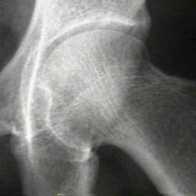 bone-density-scan-dexa-scan-osteopenia